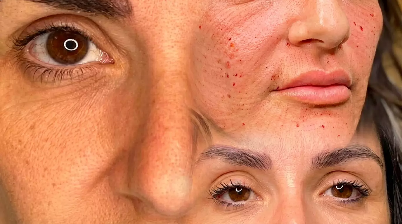 1 o 2 sesiones de fibroblast con plasma pen facial completo para 1