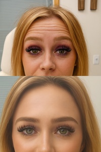 20 Units of Botox - Phluid M.E.