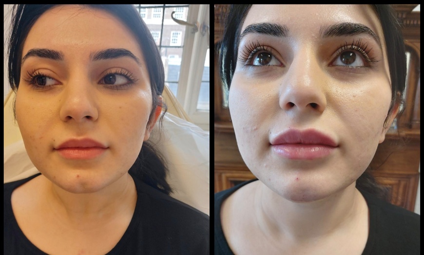 Image 2: Enhance Natural Beauty with Expert Dermal Filler Injections(0.5ml–2ml)