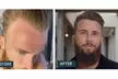 Receive A Free Dermatologist Consultation with Big Savings on Rx Hair Growth Solutions At Happy Head (Up to 60% Off) - Second Medium