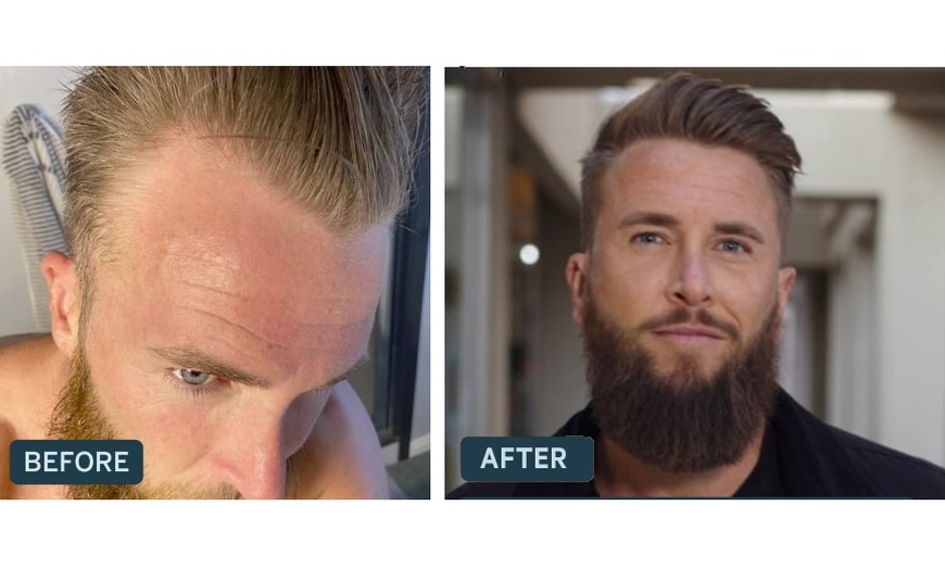 Image 4: Receive A Free Dermatologist Consultation with Big Savings on Rx Hair Growth Solutions At Happy Head