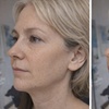 Image 6: Pick Your Perfect Botox Package: 20 or 40Units at Great Prices