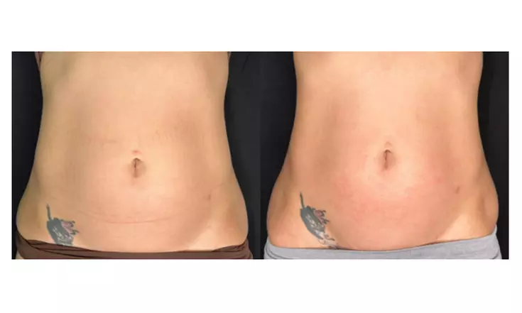 Tone with Five Sessions of Body Sculpting - Small or Large Area