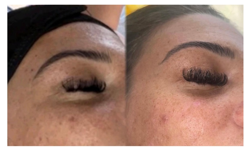 Image 4: One or Three Micro-Needling Facials with/without Skin Boosters