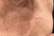 Up to 30% Off on Mole / Growth Removal at Sugar'n Sculpt Westlake - Second Medium