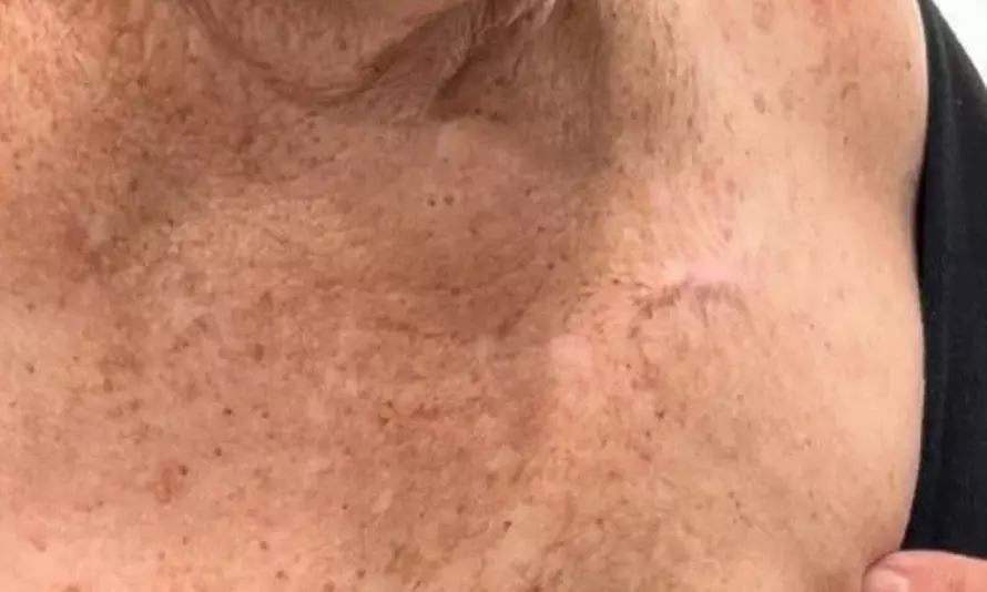 Spotless Skin: Remove 1, 3, or 5 Skin Tags, Age Spots & More 