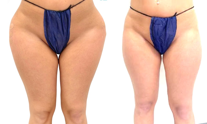 Image 4: 60 Minute Lymphatic Drainage Massage: 1 or 3 Sessions