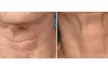 Slim Your Waistline with One, Three, or Five Laser Lipo Sessions - Up to 43% Off at Luxe Renewal Wellness Spa - Second Medium