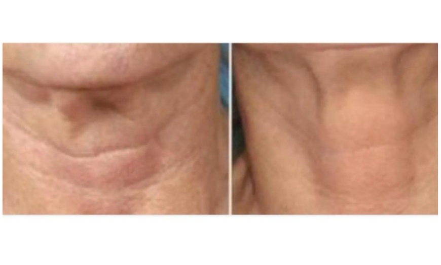 Image 2: One, Three, or Five Laser Lipo Sessions for Waistline
