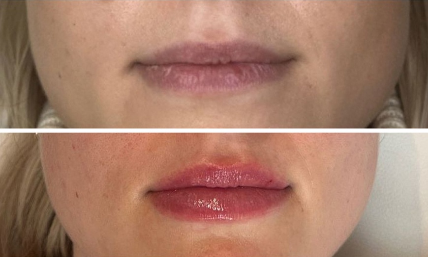 Image 8: 0.5, 1 or 2ml Dermal Filler w/ Consultation: Lip, Smile, Cheek or Chin