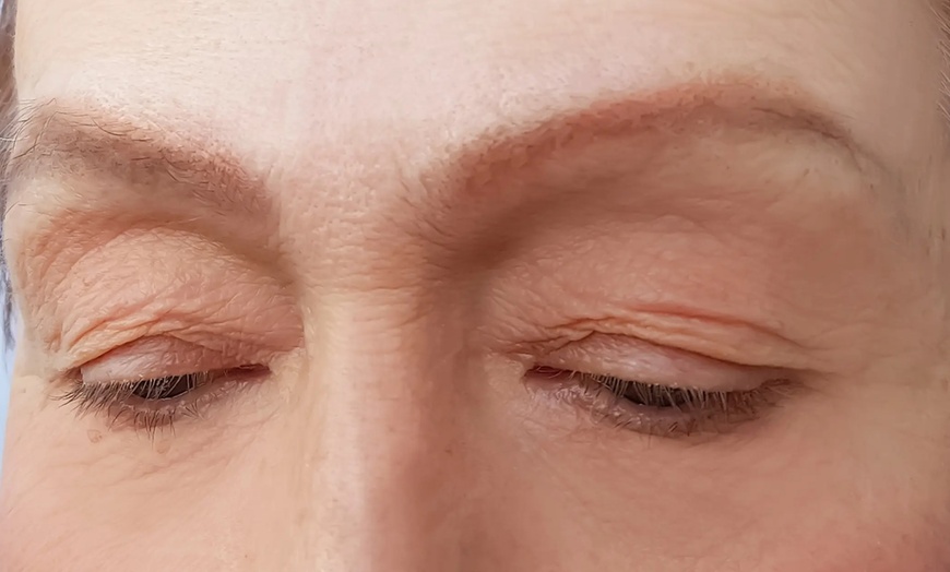 Image 2: A HIFU (Radar Carving) - Eye Area, HIFU (4D) - Face or Neck and More