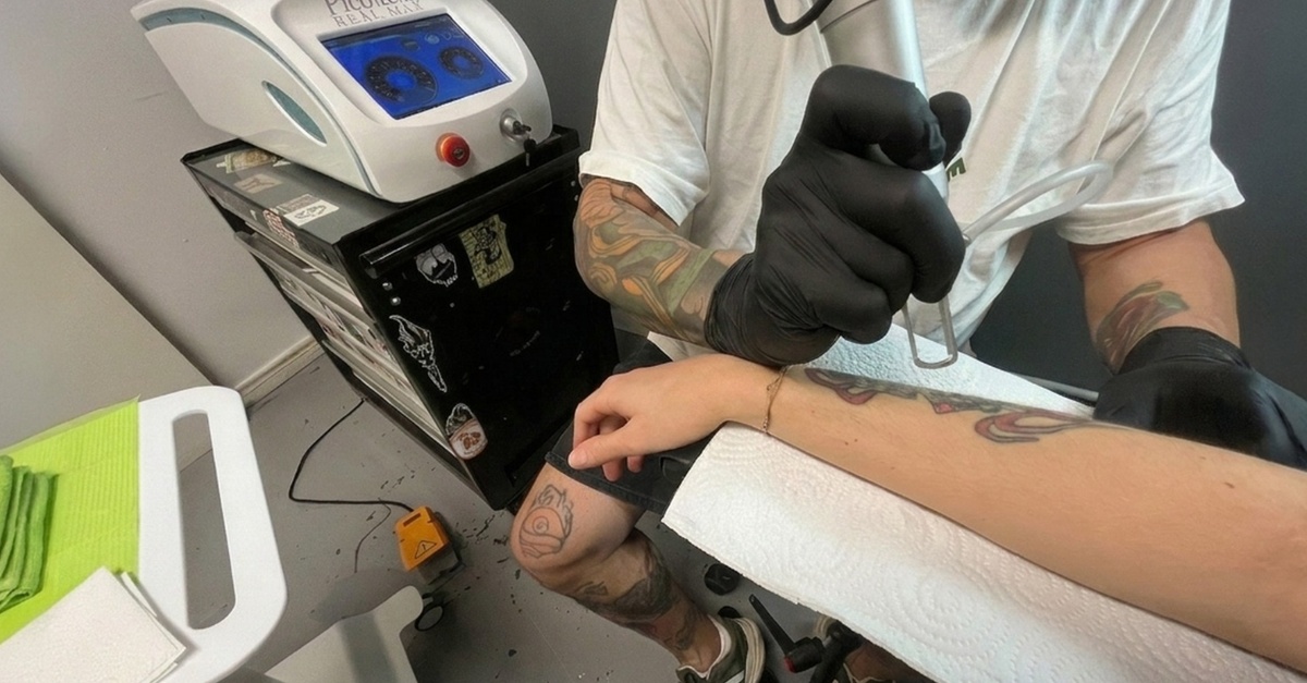 Sesiones de eliminación de tatuajes con láser en Barcelona