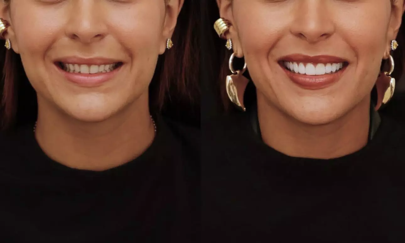 Colocación de hasta 4 carillas dentales de composite o cerámica