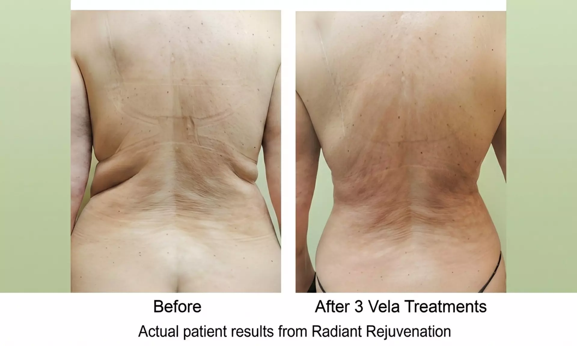 VelaShape Sessions for Targeted Body Contouring & Cellulite Reduction
