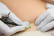 One 15-, 30 or 45-Minute Electrolysis Hair Removal Treatment (Up to 46% Off) - Second Medium