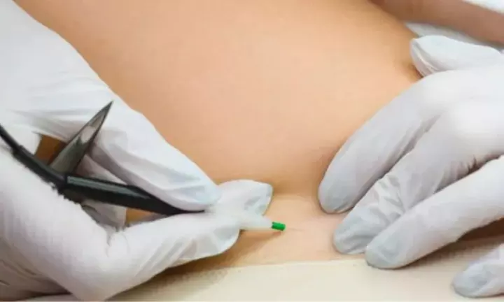One 15-, 30 or 45-Minute Electrolysis Hair Removal Treatment