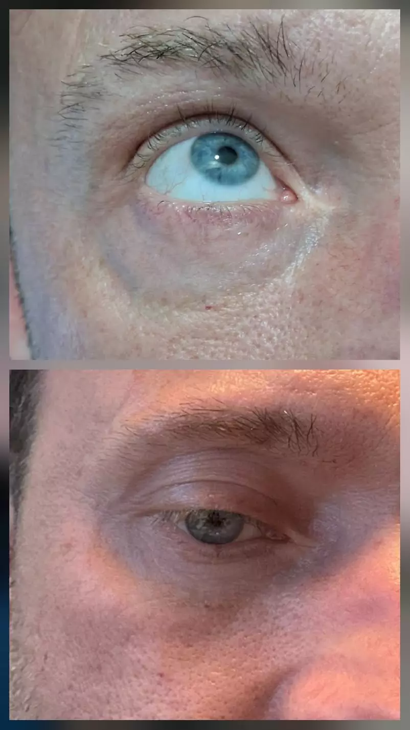 Get 1 or 2 Under Eye PRP with Platelet-Rich Plasma Sess Treatment