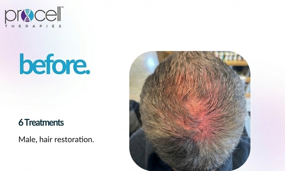 Restore w/ BOGO Half or Whole Head Procell Microchanneling Treatment