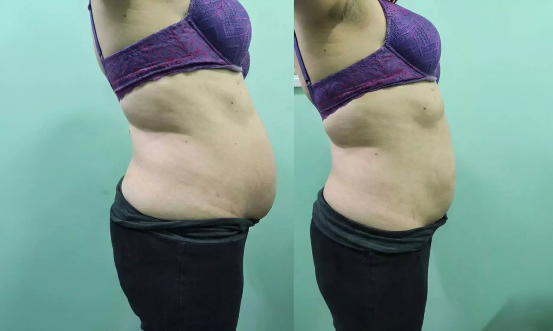 1 o 2 sesiones de 1 hora de HIFU corporal en zona a elegir para 1