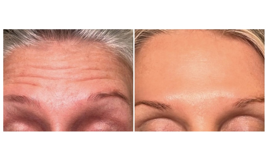 Image 2: Up to 40% Off on Injection - Botox at River Oaks Galleria Medspa