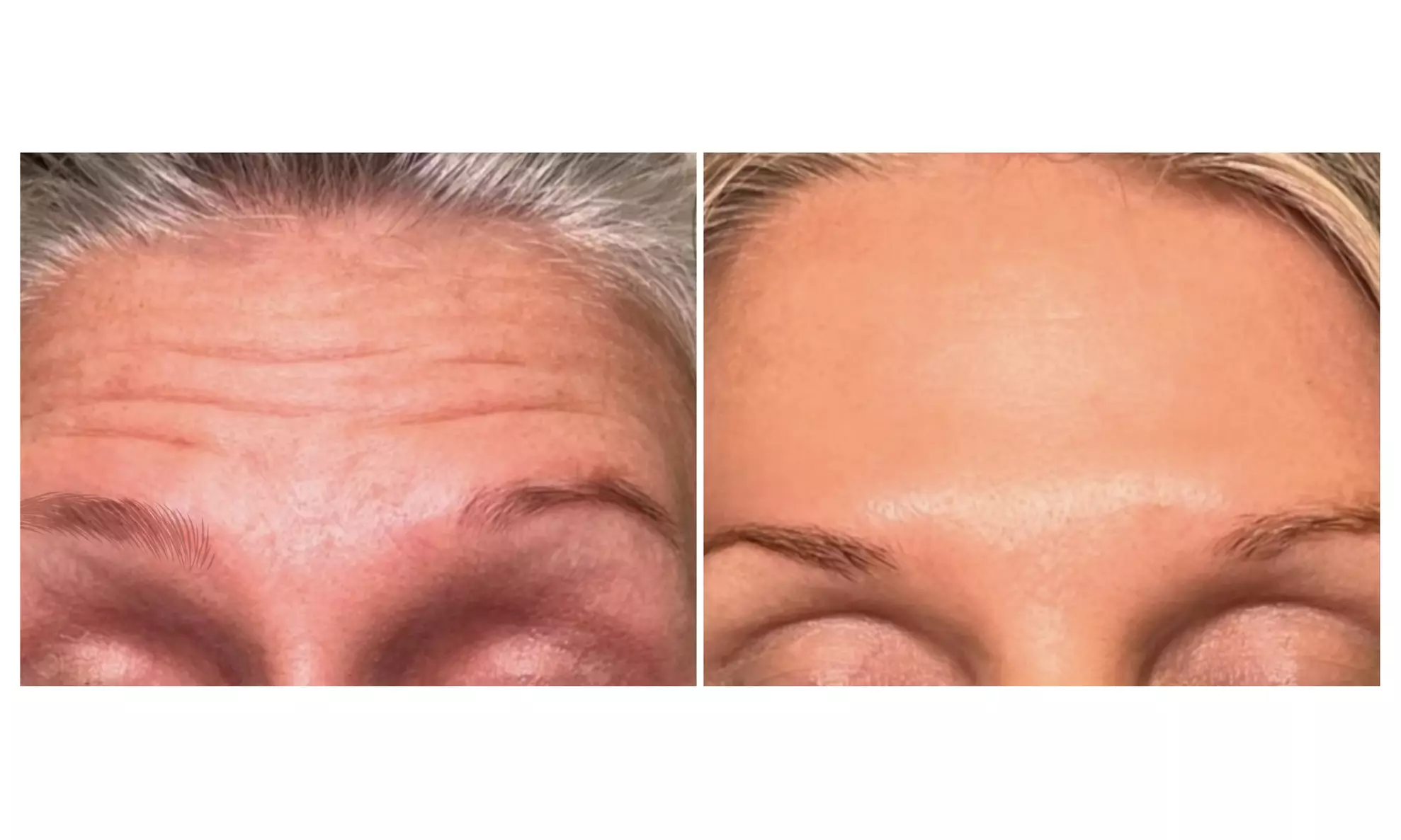 Get Smooth Skin with  20 or 40 Units of Botox 