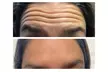 Rejuvenate Your Appearance with Sona Med Spa's  20 Units of Botox Treatment (Up to 37% Off) - Second Medium
