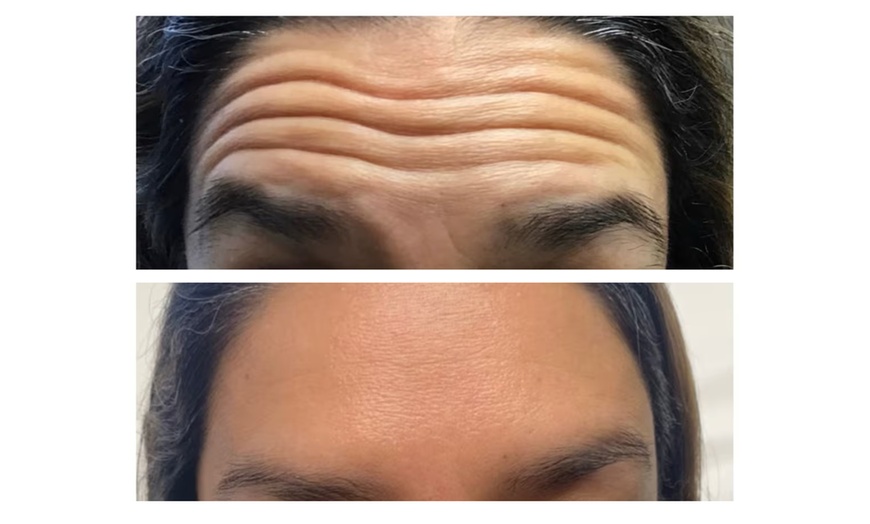 Image 4: Revitalize Your Appearance with 20 Units of Botox Treatment