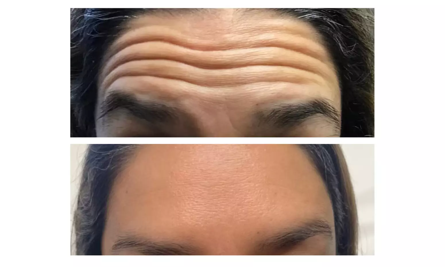 Revitalize Your Appearance with 20 Units of Botox Treatment