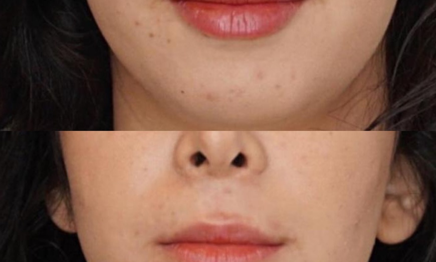 Image 2: Hyaluronic Acid Pen Dermal Filler - Lips at Envyyme