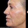 Image 1: Morpheus8 Non-surgical Tightening - Allure Passions Aesthetic Clinic