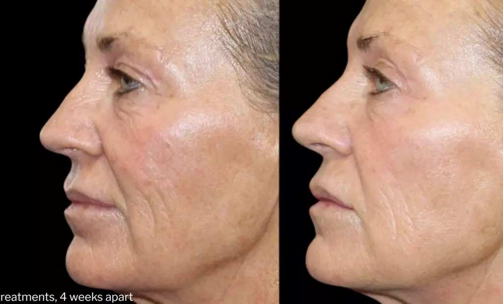 Morpheus8 Non-surgical Tightening - Allure Passions Aesthetic Clinic