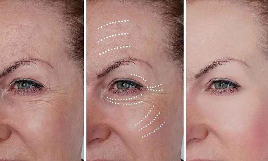 Image 2: Get One, Two, or Three Microcurrent Facelift Treatments