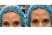 Refresh Your Look with Botox Injections in Pittsburgh – Up to 48% Off 20 or 40 Units at Luna Vision and Laser - Second Medium