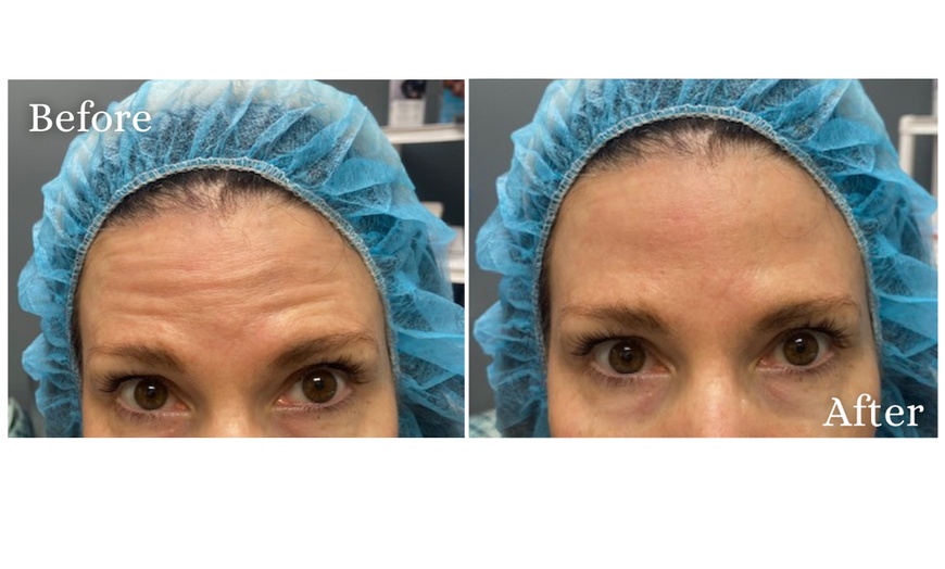 Image 2: Refresh Your Look with Botox in West Palm Beach – 20 or 40 Units