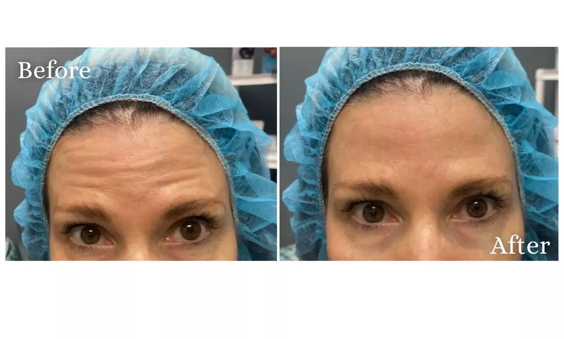 Refresh Your Look with Botox Injections in Pittsburgh – 20 or 40 Units