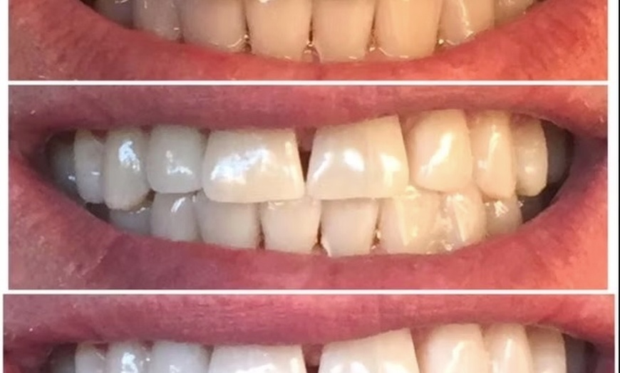 Image 3: One Three 50 Min In-Office Teeth-Whitening Treatment at BodyCocktail