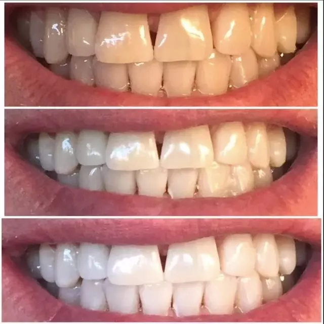 One Three 50 Min In-Office Teeth-Whitening Treatment at BodyCocktail
