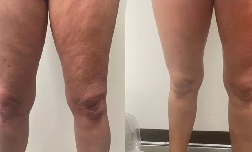 Image 3: Revitalize Skin with Micro-Needling Treatments for Cellulite