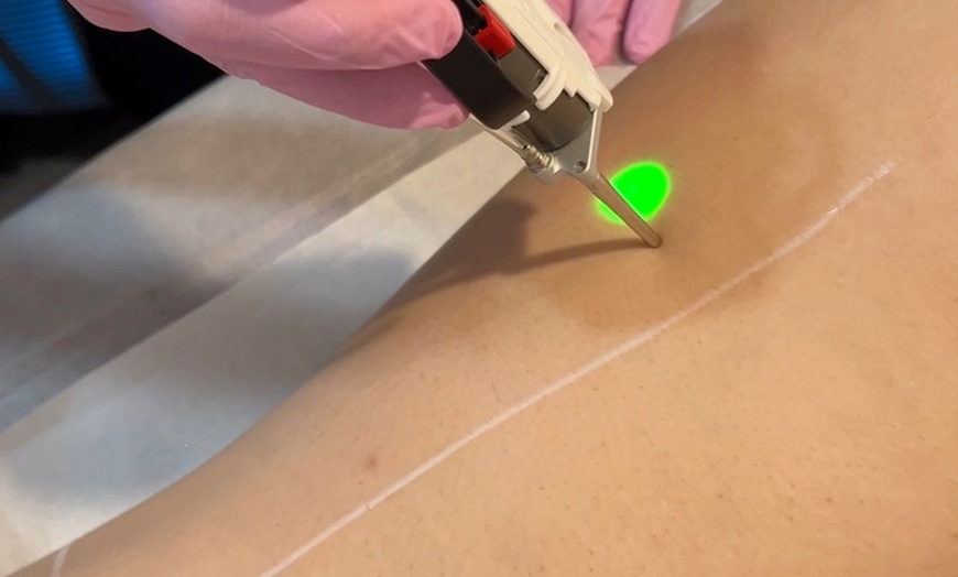 Image 2: 1 Year of Unlimited Laser Hair Removal for Small, Medium or Large Area