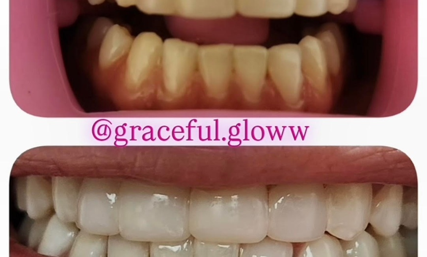 Image 3: Professional Teeth Whitening Treatments