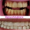 Image 3: Professional Teeth Whitening Treatments