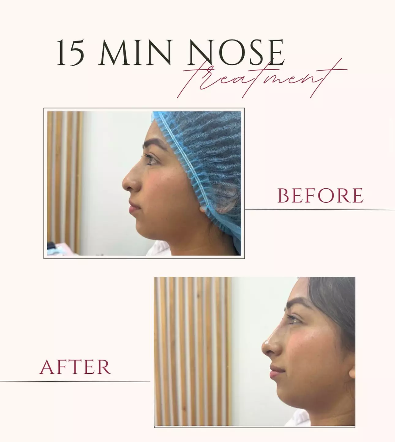 Achieve a Refreshed Look with 20, 40, or 60 Units of Botox