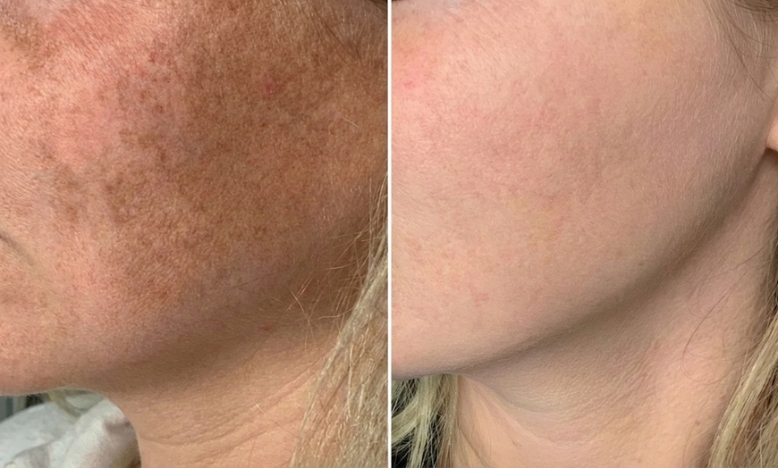 Image 2: Lumenis IPL Laser Skin Resurfacing Treatment for Face & Optional Neck