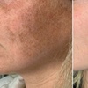 Image 2: Lumenis IPL Laser Skin Resurfacing Treatment for Face & Optional Neck
