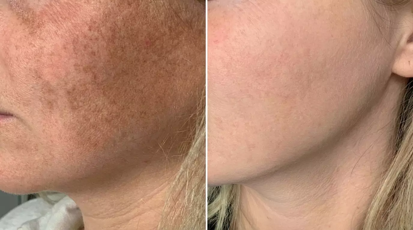 Lumenis IPL Laser Skin Resurfacing Treatment for Face & Optional Neck