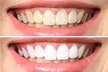 Experience Bite Professional Teeth Whitening's Level 3 for one, boasting up to 40% off - Second Medium