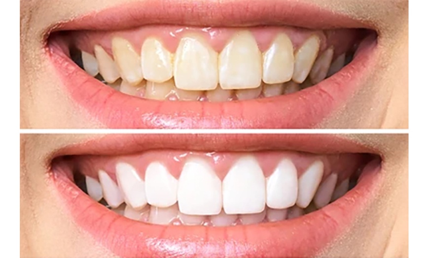 Image 1: Get a Brighter Smile with Level 3 Teeth Whitening