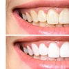 Image 1: Get a Brighter Smile with Level 3 Teeth Whitening