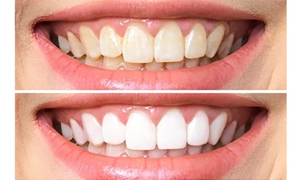 Level 3 Teeth Whitening for One - Bite Professional Teeth Whitening