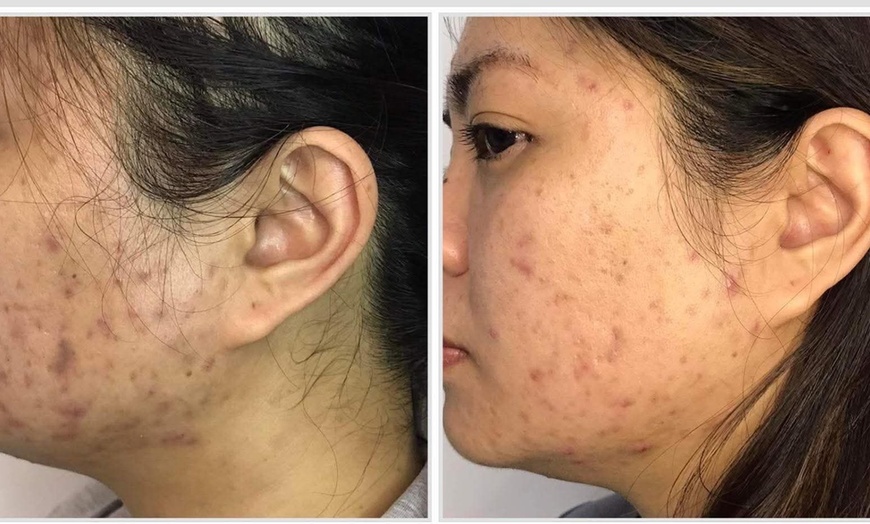 Image 6: One, Two or Three 60-Minute Signature Facials with Chemical Peels